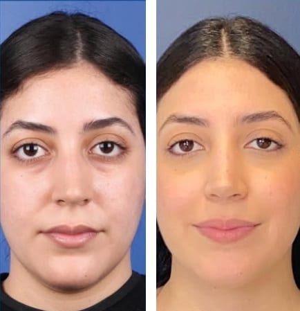 Rinoplastia caso 24 — antes y después